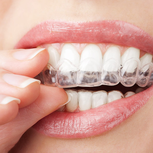 Clear Aligners